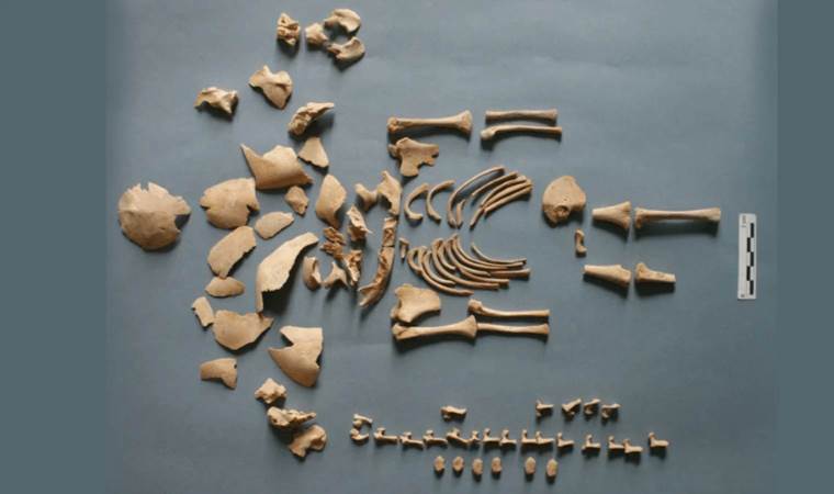 Ancient DNA unveils down syndrome in ancient graves
