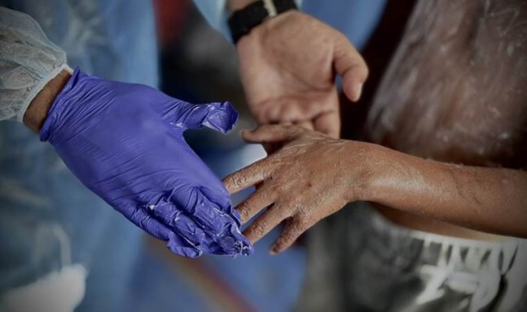 Skin infections surge in Gaza amid shortages of